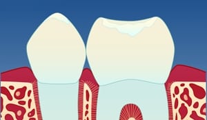 gingivitt