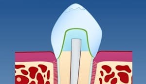 retrograd rotfylling thumb