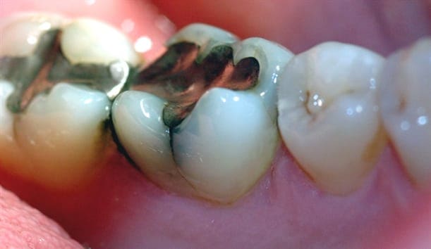 Bildet viser en jeksel i underkjeven med en stor amalgamfylling. Det går en tydelig bruddlinje langs den ene tyggeknuten.