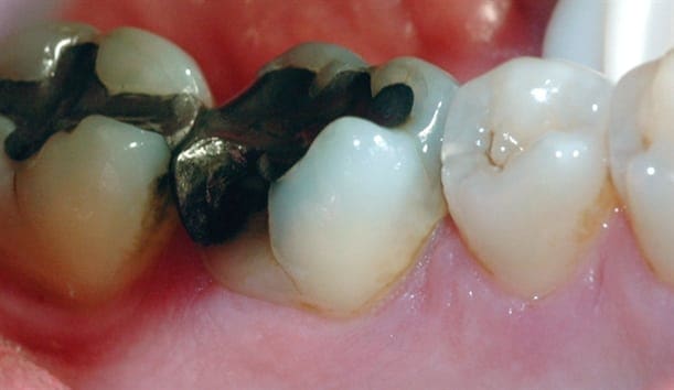 Bruddlinjen førte over tid til at tannen frakturerte.