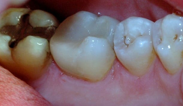 Den gjenstående amalgamfyllingen ble fjernet, og tannen ble bygget opp igjen med en plastfylling.