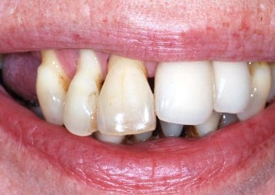 for implantatbehandling full kjeve